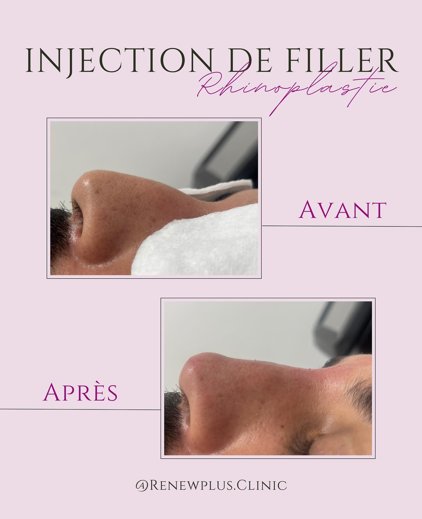 Avant Après rhinoplastie